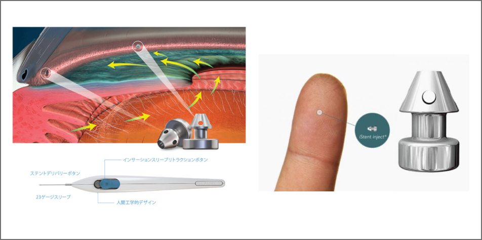 イメージ：水晶体再建術併用眼内ドレーン挿入術（iStent ®）