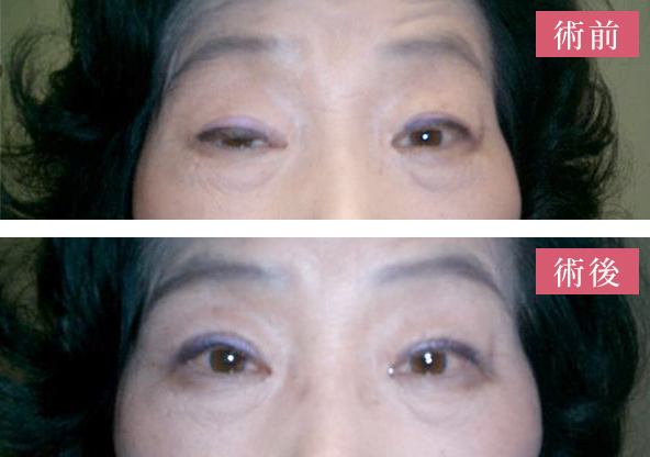 イメージ：【コンタクトレンズ使用による眼瞼下垂】挙筋短縮術後1か月