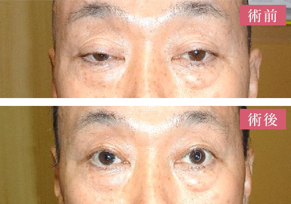 イメージ：【内眼術後、加齢性下垂】挙筋短縮術後1か月
